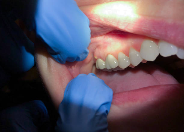 Best Broken Tooth Emergency  in Zephyrhills South, FL